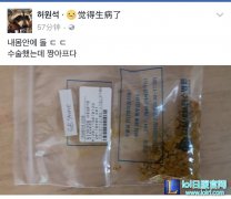 Pawn的手术完毕 取出的胆结石触目惊心,lol日服